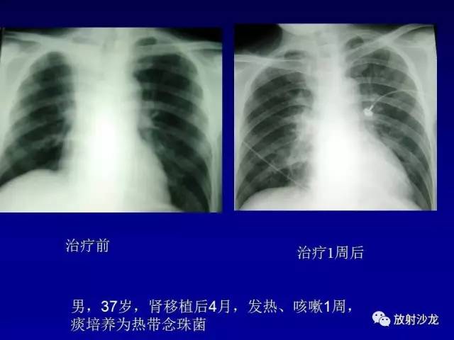 【PPT】肺真菌病的影像诊断与鉴别诊断
