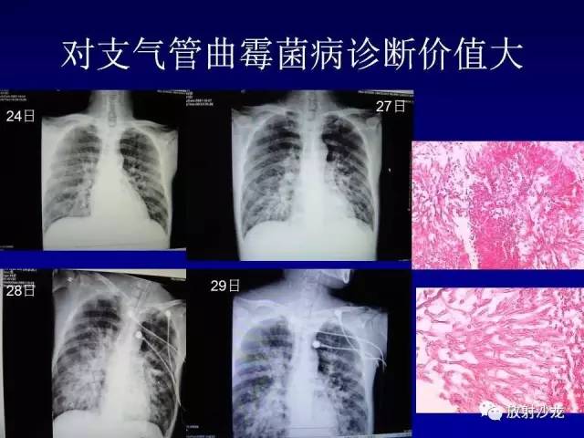 【PPT】肺真菌病的影像诊断与鉴别诊断