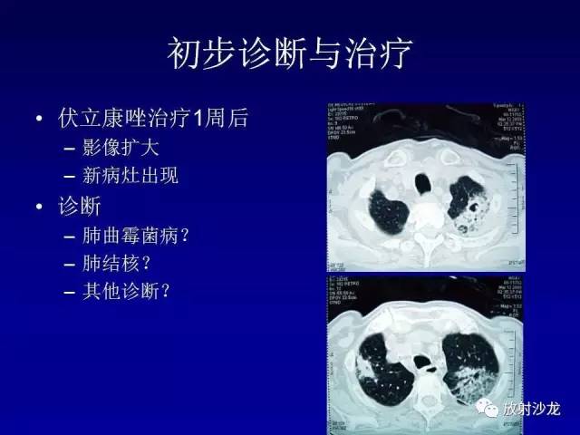 【PPT】肺真菌病的影像诊断与鉴别诊断