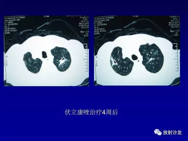 【PPT】肺真菌病的影像诊断与鉴别诊断