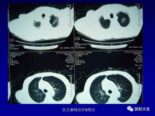 【PPT】肺真菌病的影像诊断与鉴别诊断