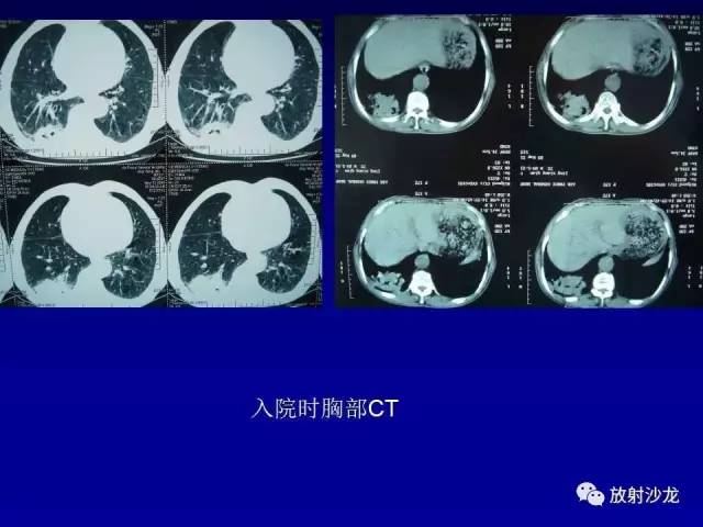 【PPT】肺真菌病的影像诊断与鉴别诊断