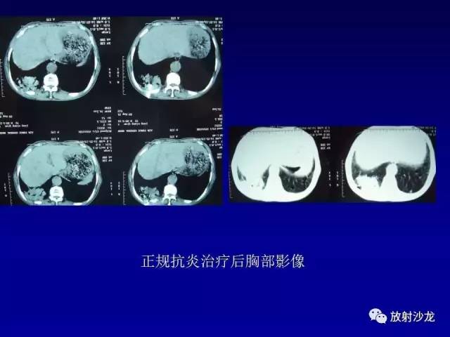 【PPT】肺真菌病的影像诊断与鉴别诊断