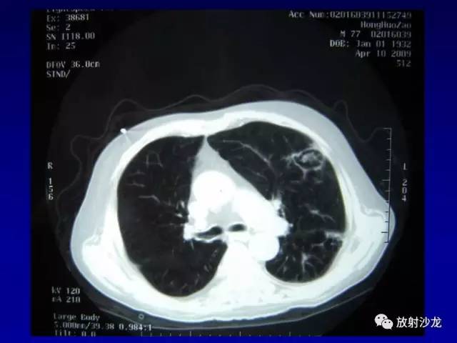 【PPT】肺真菌病的影像诊断与鉴别诊断