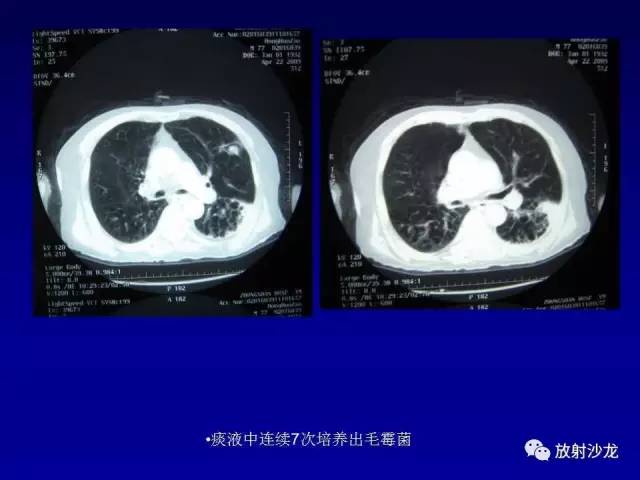 【PPT】肺真菌病的影像诊断与鉴别诊断