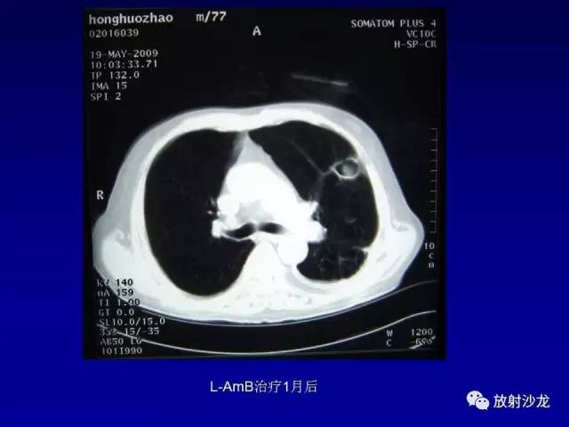 【PPT】肺真菌病的影像诊断与鉴别诊断