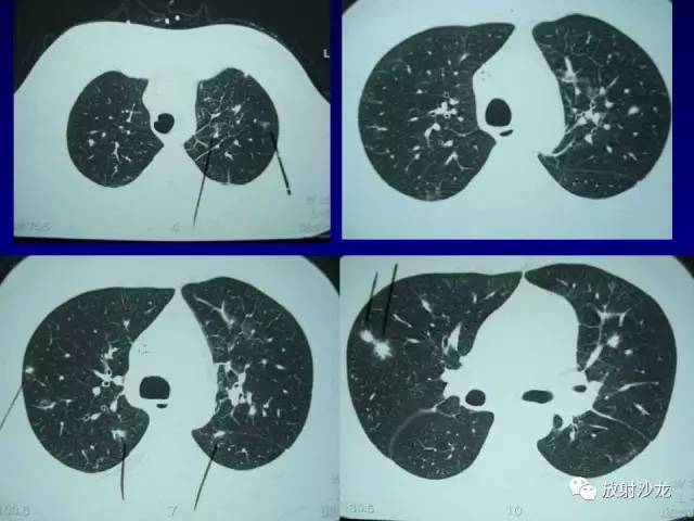 【PPT】肺真菌病的影像诊断与鉴别诊断