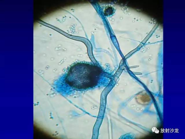 【PPT】肺真菌病的影像诊断与鉴别诊断