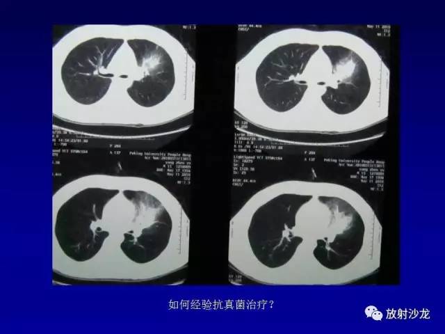 【PPT】肺真菌病的影像诊断与鉴别诊断
