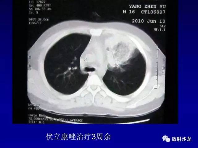 【PPT】肺真菌病的影像诊断与鉴别诊断