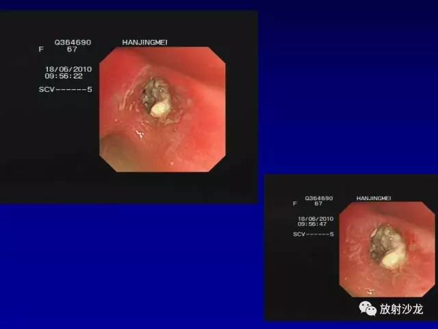 【PPT】肺真菌病的影像诊断与鉴别诊断