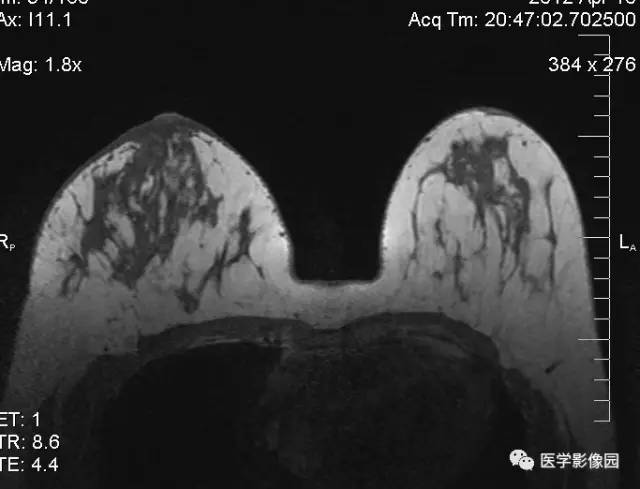 【病例】浆细胞性乳腺炎1例MR影像表现 【病例】浆细胞性乳腺炎1例MR影像表现