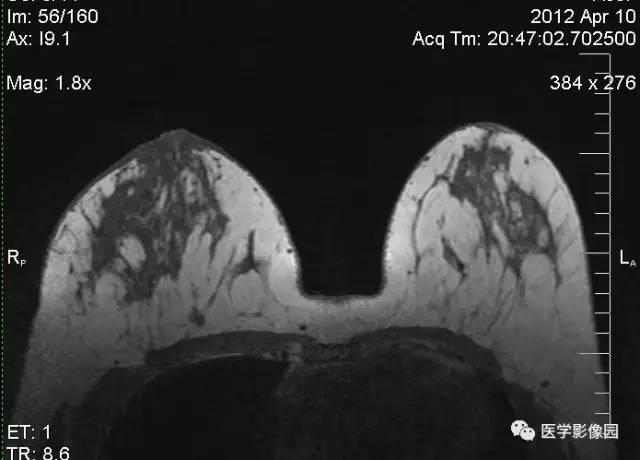 【病例】浆细胞性乳腺炎1例MR影像表现 【病例】浆细胞性乳腺炎1例MR影像表现