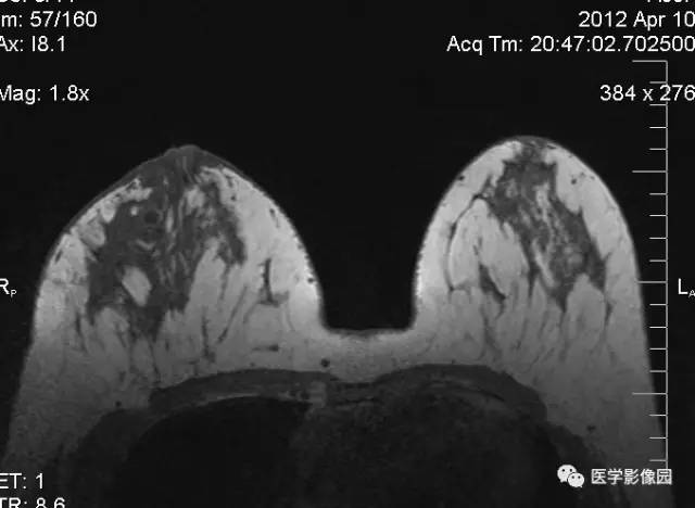 【病例】浆细胞性乳腺炎1例MR影像表现 【病例】浆细胞性乳腺炎1例MR影像表现