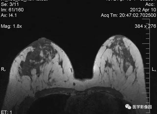【病例】浆细胞性乳腺炎1例MR影像表现 【病例】浆细胞性乳腺炎1例MR影像表现