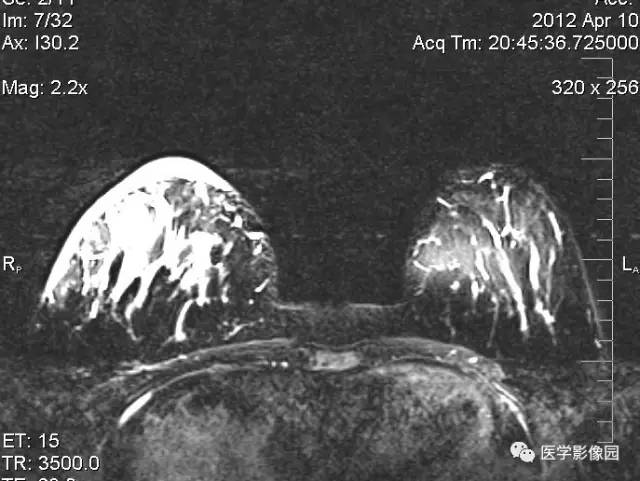 【病例】浆细胞性乳腺炎1例MR影像表现
