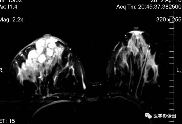 【病例】浆细胞性乳腺炎1例MR影像表现 【病例】浆细胞性乳腺炎1例MR影像表现