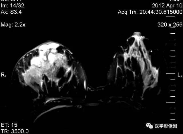 【病例】浆细胞性乳腺炎1例MR影像表现 【病例】浆细胞性乳腺炎1例MR影像表现