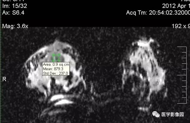 【病例】浆细胞性乳腺炎1例MR影像表现 【病例】浆细胞性乳腺炎1例MR影像表现