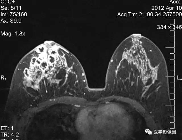 【病例】浆细胞性乳腺炎1例MR影像表现 【病例】浆细胞性乳腺炎1例MR影像表现
