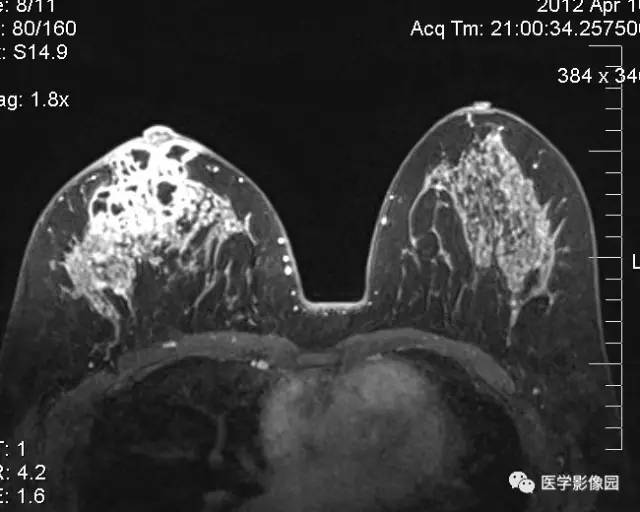 【病例】浆细胞性乳腺炎1例MR影像表现 【病例】浆细胞性乳腺炎1例MR影像表现