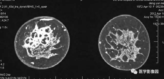 【病例】浆细胞性乳腺炎1例MR影像表现 【病例】浆细胞性乳腺炎1例MR影像表现