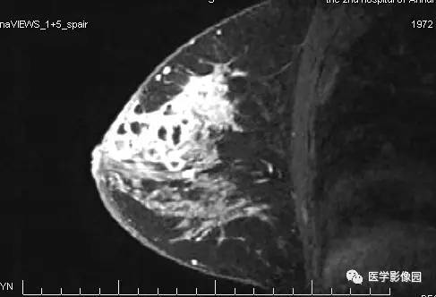 【病例】浆细胞性乳腺炎1例MR影像表现 【病例】浆细胞性乳腺炎1例MR影像表现