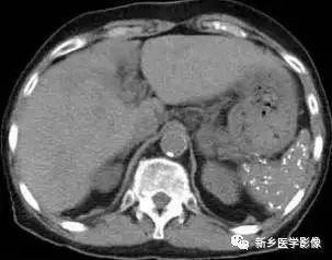 经常看到脾脏钙化,您知道这10种原因吗? 经常看到脾脏钙化,您知道这10种原因吗?