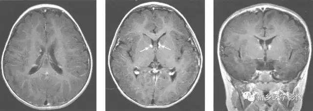 【病例】结节性硬化1例MR影像表现