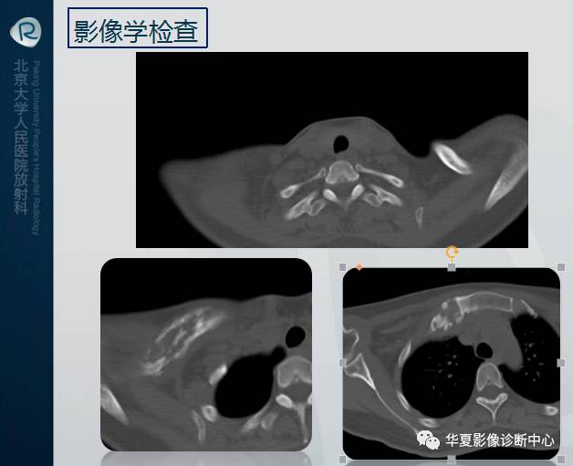 【病例】SAPHO综合征1例CT影像表现
