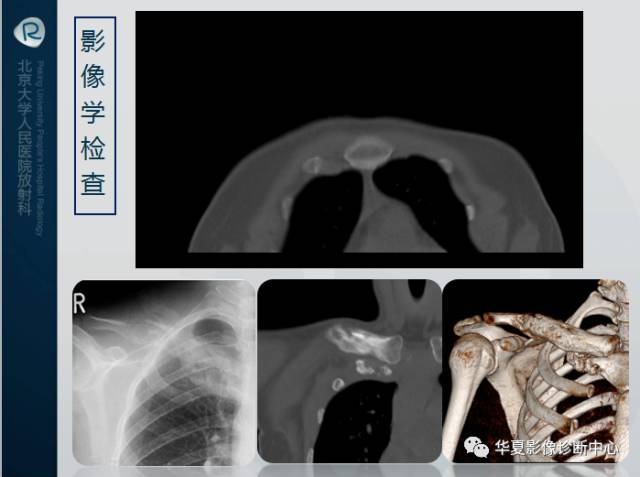 【病例】SAPHO综合征1例CT影像表现