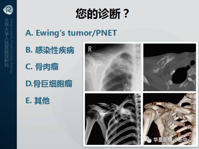 【病例】SAPHO综合征1例CT影像表现
