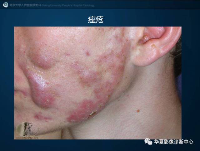 【病例】SAPHO综合征1例CT影像表现
