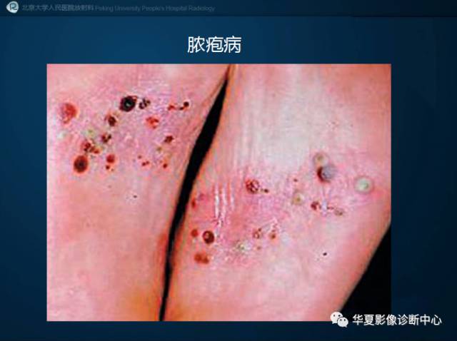 【病例】SAPHO综合征1例CT影像表现