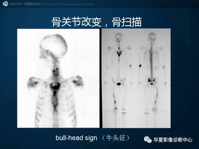 【病例】SAPHO综合征1例CT影像表现