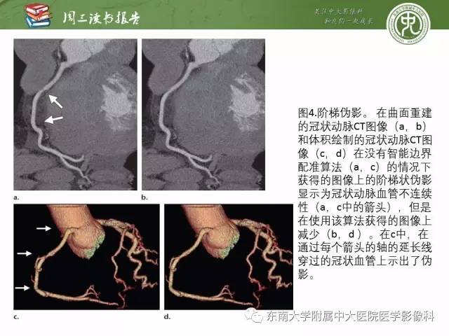 【PPT】冠状动脉CT成像新技术【RG精选】