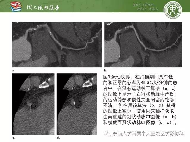 【PPT】冠状动脉CT成像新技术【RG精选】