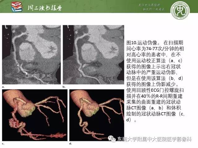 【PPT】冠状动脉CT成像新技术【RG精选】