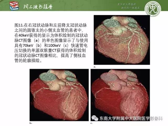 【PPT】冠状动脉CT成像新技术【RG精选】