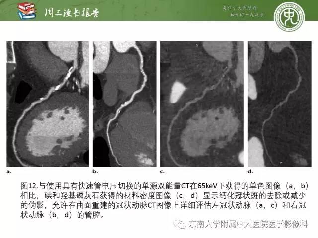 【PPT】冠状动脉CT成像新技术【RG精选】
