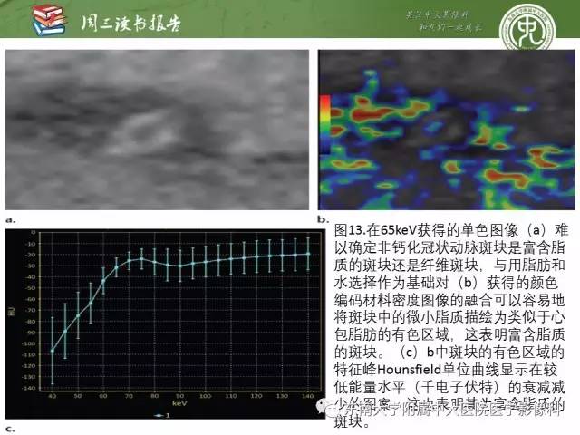 【PPT】冠状动脉CT成像新技术【RG精选】