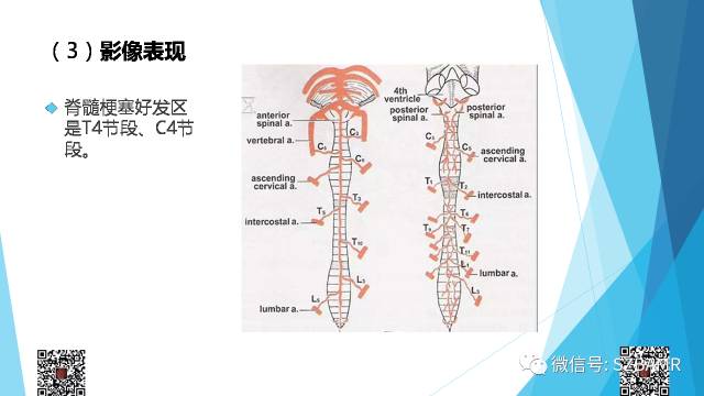 【PPT】脊髓常见血管性病变的临床与影像