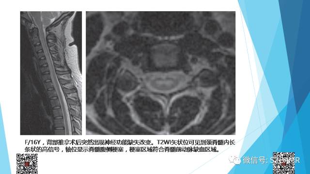【PPT】脊髓常见血管性病变的临床与影像