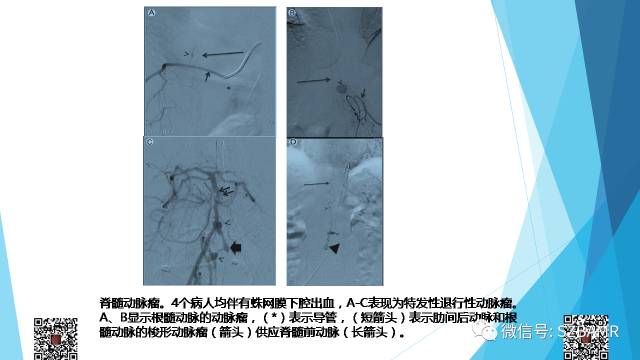 【PPT】脊髓常见血管性病变的临床与影像