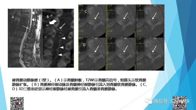 【PPT】脊髓常见血管性病变的临床与影像