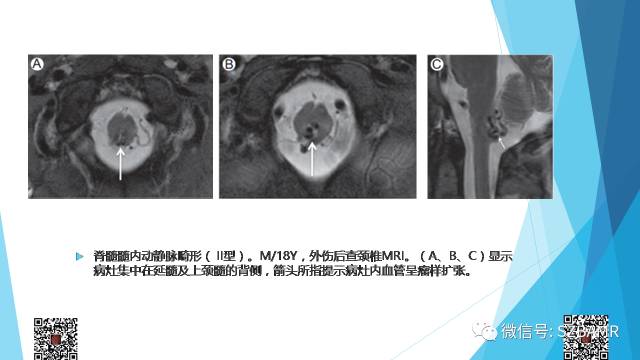 【PPT】脊髓常见血管性病变的临床与影像