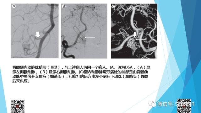 【PPT】脊髓常见血管性病变的临床与影像