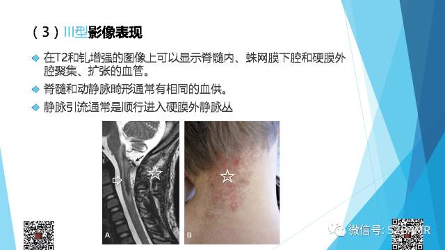 【PPT】脊髓常见血管性病变的临床与影像