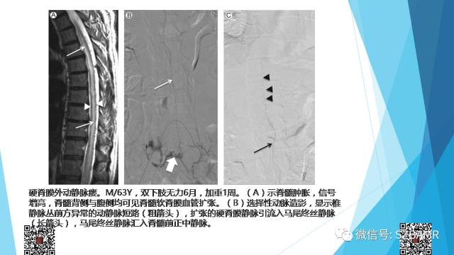 【PPT】脊髓常见血管性病变的临床与影像