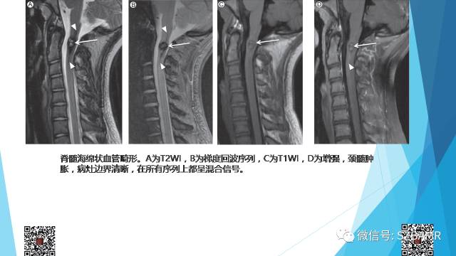 【PPT】脊髓常见血管性病变的临床与影像